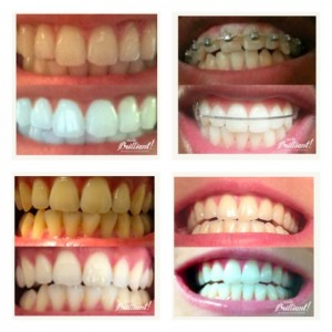 SmileBrilliant Custom Fitted Tray Kit Plus 3 Whitening Gels Giveaway ends 9/23
